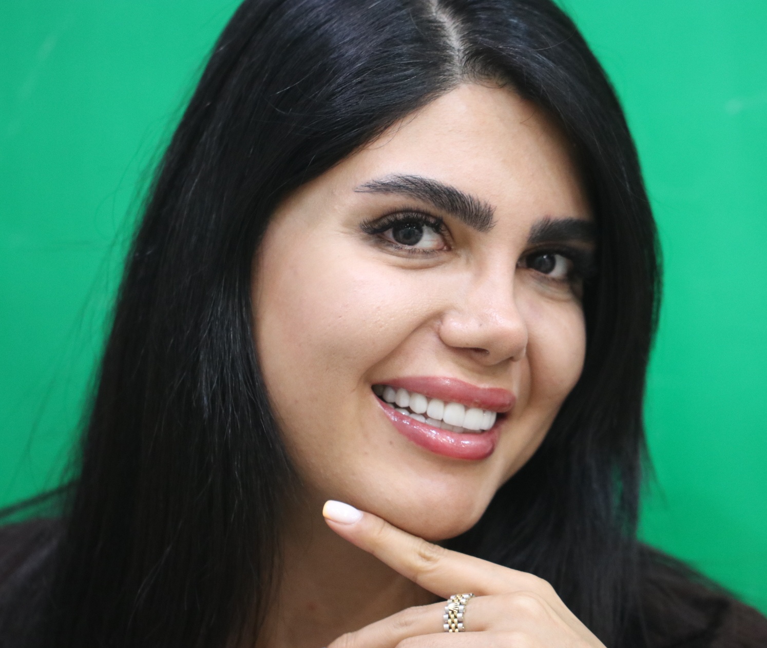 نمونه درمان لمینیت سرامیک