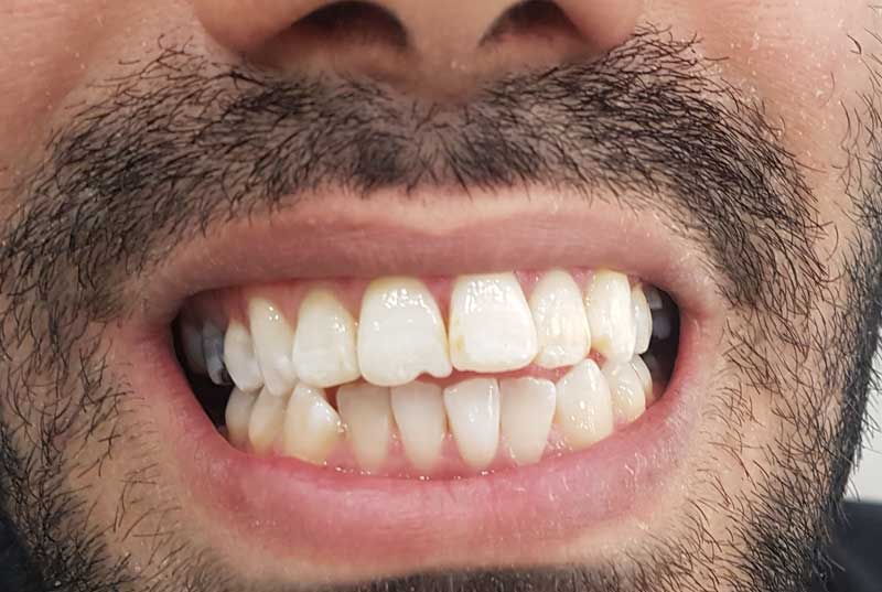 پایان درمان بدون تراش و آسیب به دندان