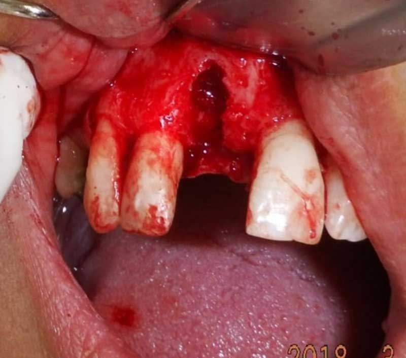 میزان ازبین رفتن استخوان به صورت یک شکاف به علت عفونت دندان که قبلا کشیده شده مشخص است