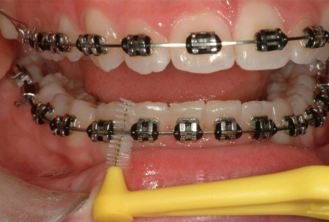 دکتر سعیده شادلو - دکتر مجید قریشی -بهداشت دهان و دندان در طی درمان ارتودنسی